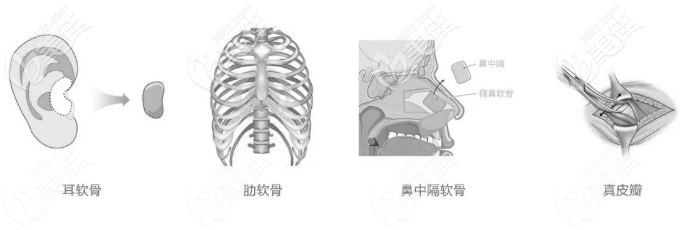 常用的自身取材隆鼻材料