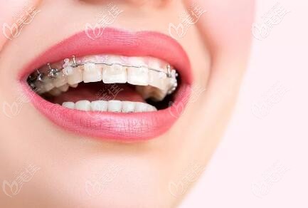 陶瓷半隐形矫正 陶瓷半隐形矫正