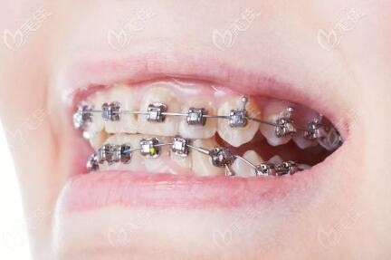 金属钢牙套 金属钢牙套