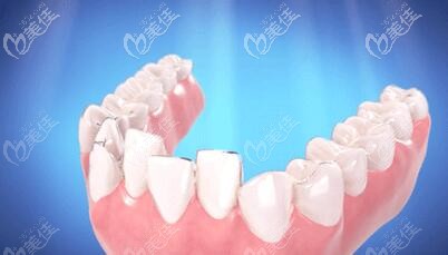 无托槽隐形矫治 无托槽隐形矫治