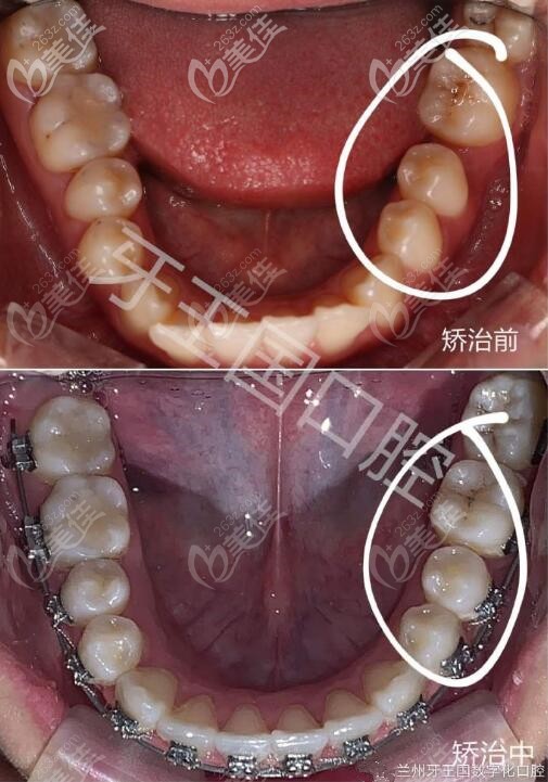 缺牙智齿牵引成功啦,金属自锁托槽矫正历时1年半关闭间隙