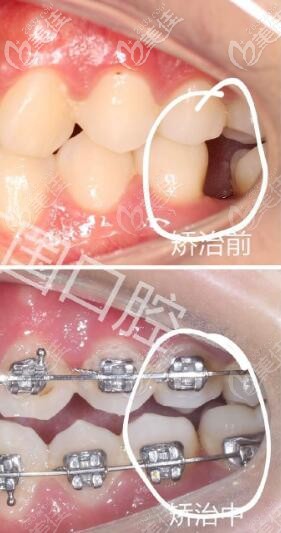兰州牙王国数字化口腔 正畸关闭间隙 兰州牙王国数字化口腔 正畸关闭间隙