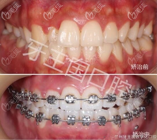 兰州牙王国数字化口腔正畸<span style= 兰州牙王国数字化口腔正畸<span style=