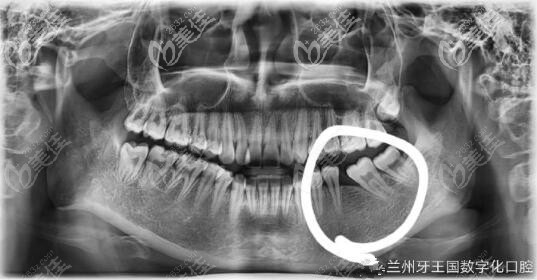 智齿拉过来当磨牙 兰州牙王国口腔 智齿拉过来当磨牙 兰州牙王国口腔