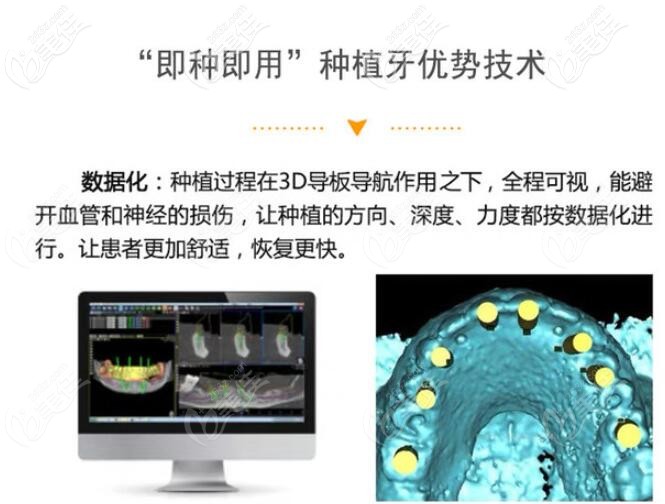 南京卡瓦口腔即刻种植牙怎么样 南京卡瓦口腔即刻种植牙怎么样