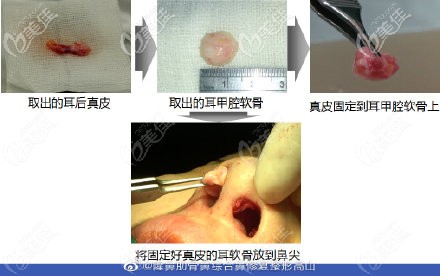 真皮垫鼻尖的过程 真皮垫鼻尖的过程