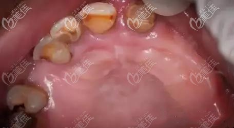 南宁牙百年口腔上颌种植牙前的照片 南宁牙百年口腔上颌种植牙前的照片