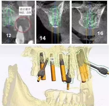 南宁牙百年口腔半口种植牙3D导板