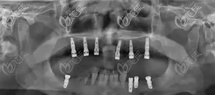 南宁牙百年口腔上颌种植牙术后CT 南宁牙百年口腔上颌种植牙术后CT