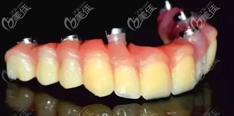 南宁牙百年口腔上半口种植牙临时牙冠