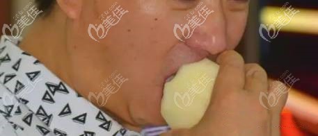 南宁牙百年口腔上半口种植牙案例 南宁牙百年口腔上半口种植牙案例