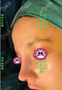 找北京做鼻综合好的<!--<i data=20240703-sp></i>-->做鼻修复术后即刻照 找北京做鼻综合好的<!--<i data=20240703-sp></i>-->做鼻修复术后即刻照