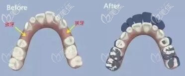 牙齿矫正是否拔牙 牙齿矫正是否拔牙