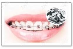 牙齿矫正 牙齿矫正
