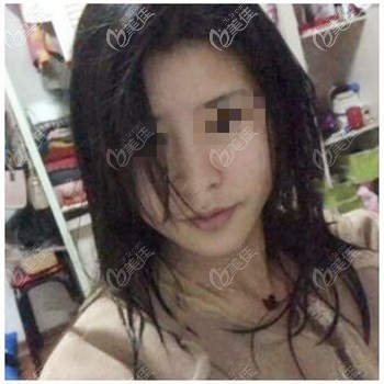 隆鼻手术前 隆鼻手术前