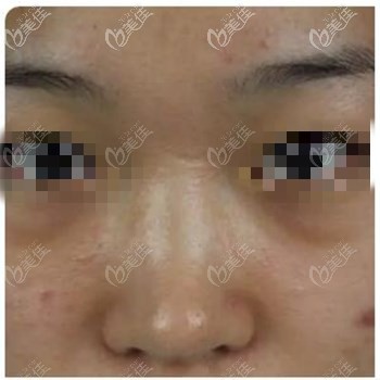 山根低适合假体还是鼻综合? 山根低适合假体还是鼻综合?