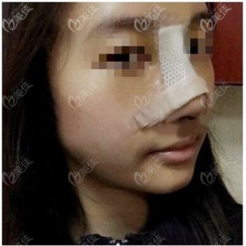 鼻综合术后三天效果 鼻综合术后三天效果