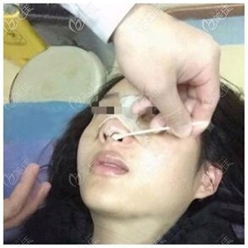 鼻综合7天拆线 鼻综合7天拆线