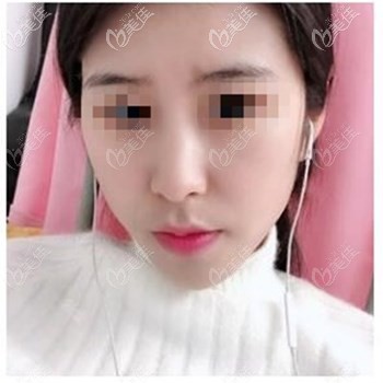 鼻综合术后1个半月恢复效果 鼻综合术后1个半月恢复效果