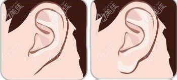 玻尿酸丰耳唇对比效果图 玻尿酸丰耳唇对比效果图