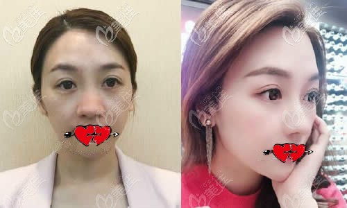 我做耳后筋膜包裹硅胶假体隆鼻一年后效果对比照片 我做耳后筋膜包裹硅胶假体隆鼻一年后效果对比照片