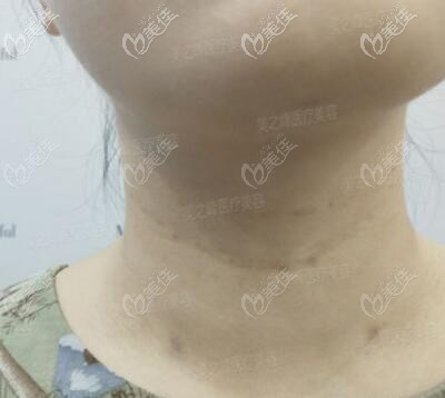 打完嗨体去颈纹术后5天恢复效果照