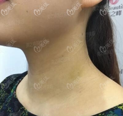嗨体去颈纹术后10天恢复照