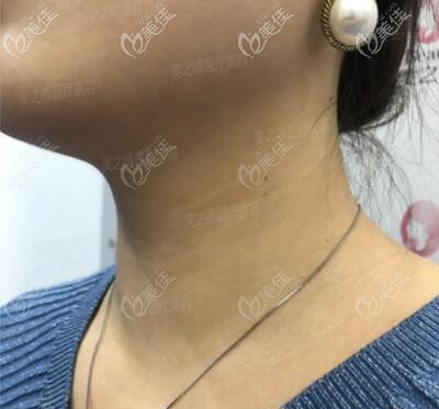 我去长沙美之峰注射嗨体去颈纹，10天见效很明显，1个月重现年轻美颈！