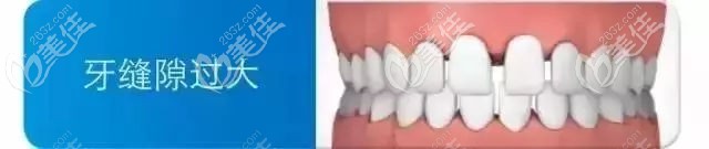 牙间隙过大的症状