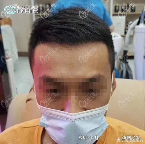 西宁碧莲盛雄性发际线脱发植发1000单位的效果图来喽!