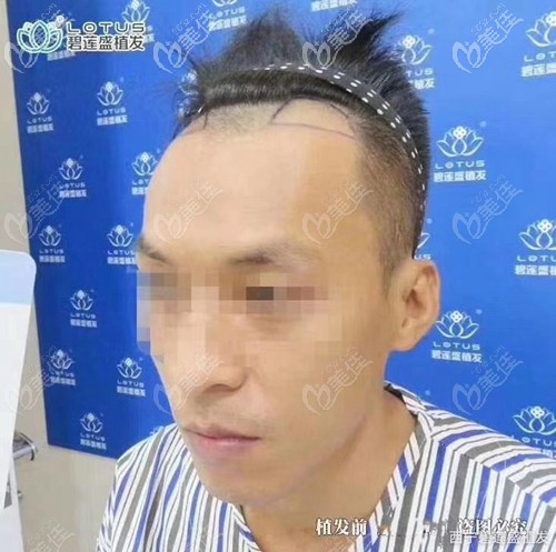 西宁碧莲盛雄性发际线脱发植发1000单位的效果图来喽