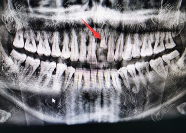 因为意外折断的门牙 因为意外折断的门牙