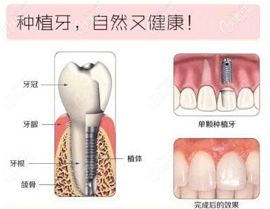 网上找的图，因为植体是在无菌环境下密封保存