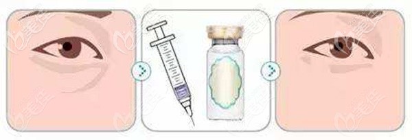 注射填充泪沟术后的效果