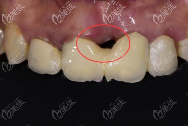 前门牙种植牙失败案例图 前门牙种植牙失败案例图
