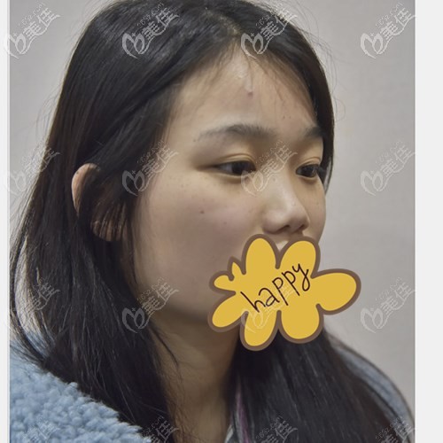 肋软骨隆鼻前鼻子塌、短 肋软骨隆鼻前鼻子塌、短