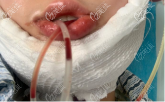 下颌角手术后插着导流管的样子 下颌角手术后插着导流管的样子