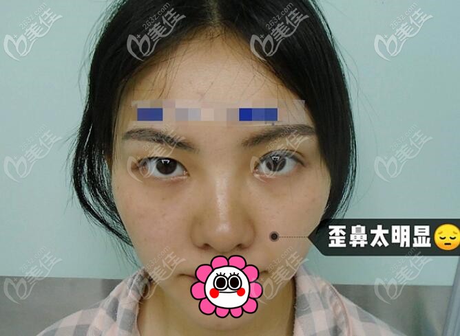 到成都素美做隆鼻前 到成都素美做隆鼻前