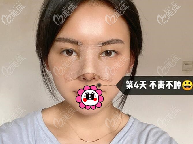 卢元刚隆鼻恢复4天已经不青不肿 卢元刚隆鼻恢复4天已经不青不肿