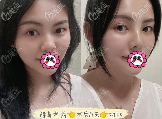 成都素美隆鼻后对比效果 成都素美隆鼻后对比效果