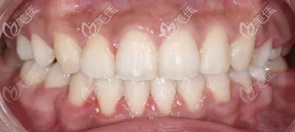 在佛山拜尔牙科矫正牙齿后的效果图