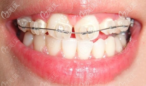 在佛山做牙齿矫正的参考价格介绍 在佛山做牙齿矫正的参考价格介绍