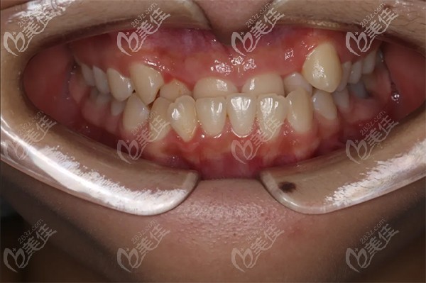 柳女士牙齿矫正前的状态 柳女士牙齿矫正前的状态