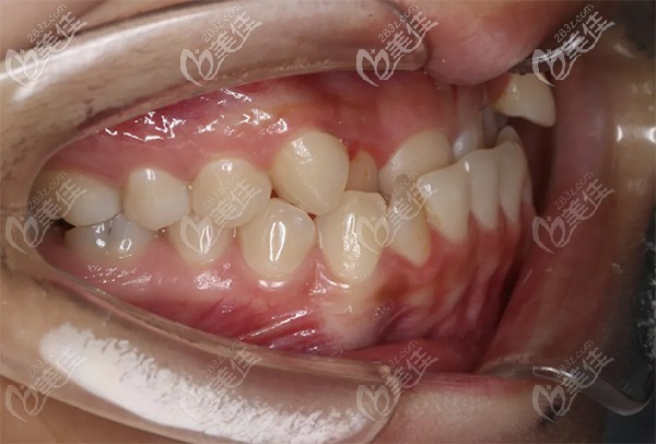柳同学口腔检查后的总体情况 柳同学口腔检查后的总体情况