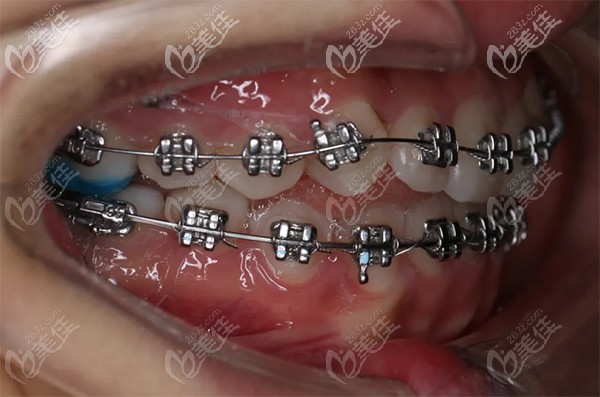 唇侧金属固定矫正和美国MBT直丝弓矫治 唇侧金属固定矫正和美国MBT直丝弓矫治