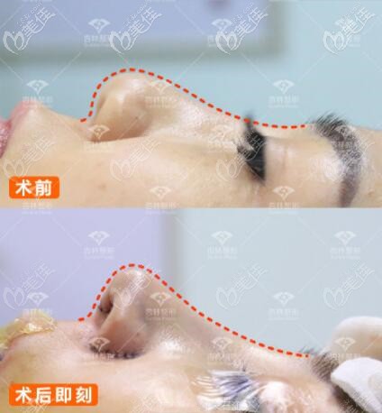 沈阳杏林朱石江肋软骨隆鼻真人案例对比图 沈阳杏林朱石江肋软骨隆鼻真人案例对比图