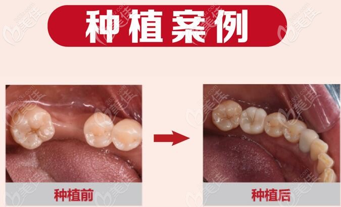  今天，是我后磨牙缺失在南京六合值德口腔做德国camlog种植牙的第4个月