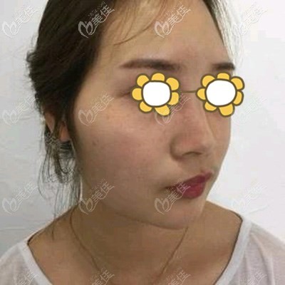 做黄金微雕前顾客的脸上明显肉多 做黄金微雕前顾客的脸上明显肉多