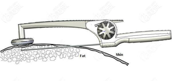 黄金微雕溶脂的原理 黄金微雕溶脂的原理