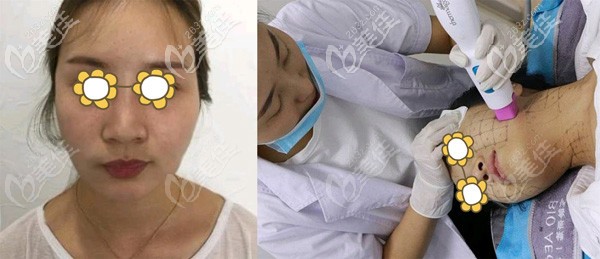 溶脂后皮肤松弛做热玛吉改善 溶脂后皮肤松弛做热玛吉改善